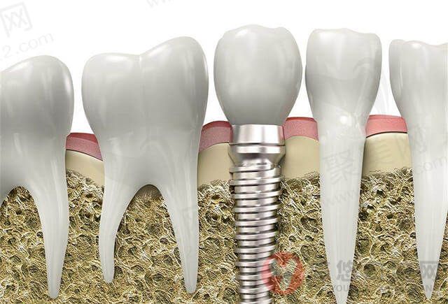 种植牙示意图