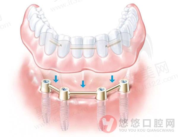 all-on-4种植牙